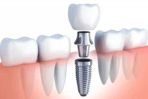 Implantologia dentale e Rigenerazione ossea - Studi Medici Odontoiatrici a Nardò